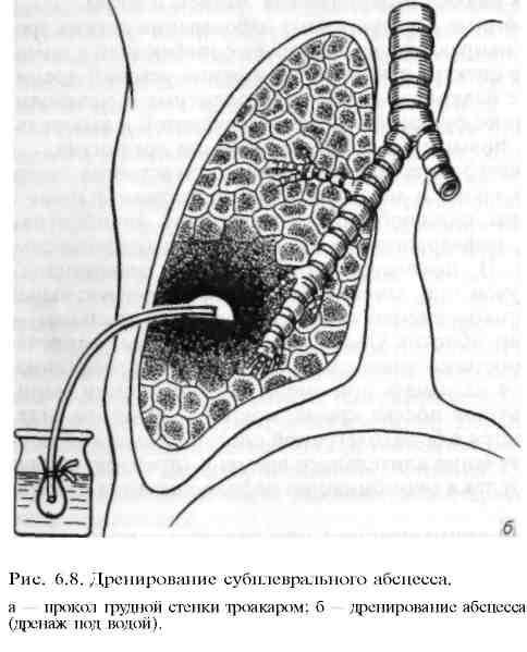 Абсцесс легкого операция. Дренирование абсцесса лёгкого. Чрескожное дренирование абсцесса. Трансторакальное дренирование полости абсцесса. Дренирование полости абсцесса легкого.